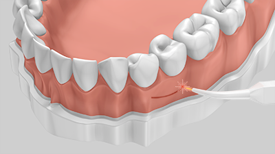 Dentallaser sorgen für eine präzise Schnittführung bei gleichzeitig geringer Blutung