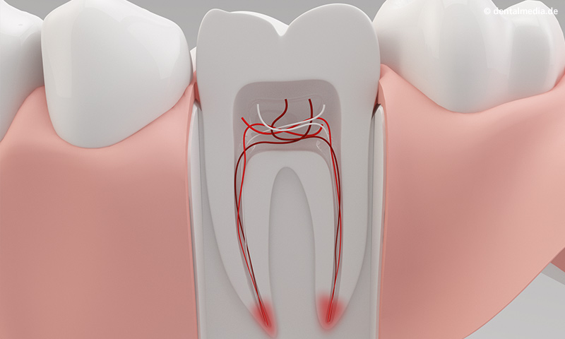 Eine endodontische Erkrankung entsteht durch Kariesbaktieren, die sich im Inneren des Zahns ausbreiten