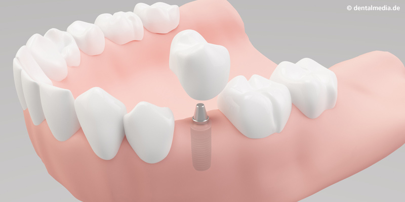Ein Implantat kann einen fehlenden Zahn ersetzen, ohne dass dafür die Nachbarzähne beschliffen werden müssen
