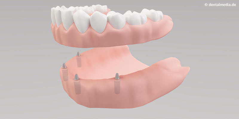 Voll- bzw. Teilprothesen kommen immer dann zur Anwendung, wenn viele oder sogar alle Zähne fehlen