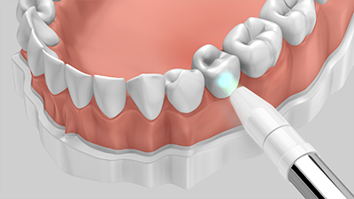 Ein Laser kann zum Bleaching (auch Zahnaufhellung genannt) zum Einsatz kommen, was als schonendes Verfahren bekannt ist