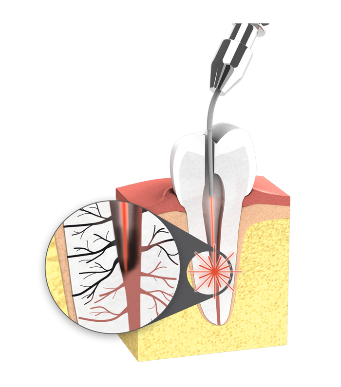 Zur Wurzelkanalbehandlung kann ein Laser zum Einsatz kommen, welcher die Baktieren in den Wurzelkanälen abtötet