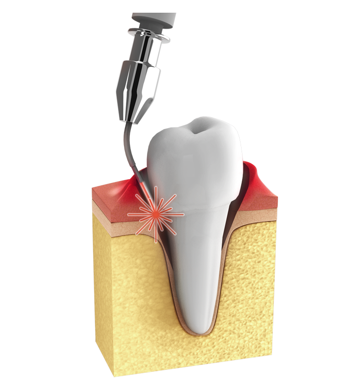 Zahnfleischtaschen bzw. die darin befindlichen Baktieren lassen sich nachhaltig mit einem Laser behandeln