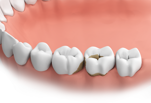 Zahnbeläge sind die Hauptursache für Karies und Parodontitis und sollten regelmäßig bei einer PZR entfernt werden